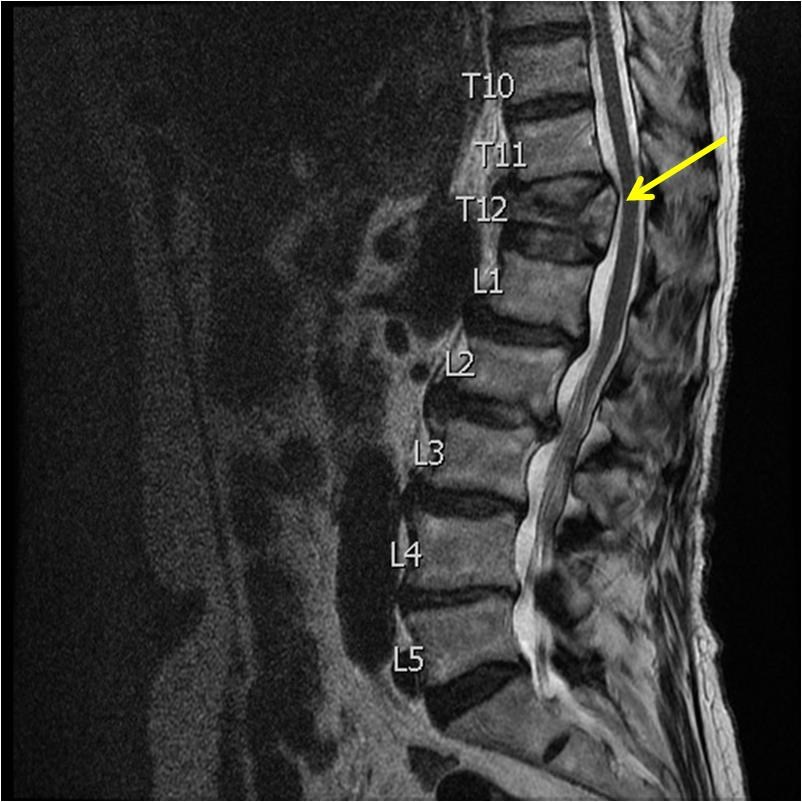 X-ray of injured spine